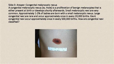 Mole Or Melanoma Test Yourself With These Suspicious