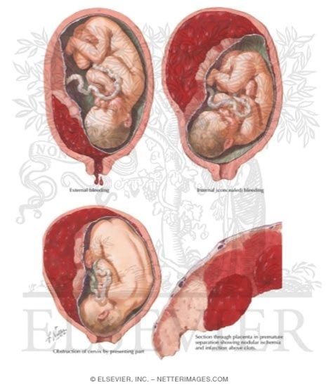 Top 96 Pictures Pictures Of Placenta On Ultrasound Full Hd 2k 4k