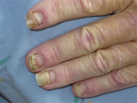 Figure Nail Psoriasis Statpearls Ncbi Bookshelf