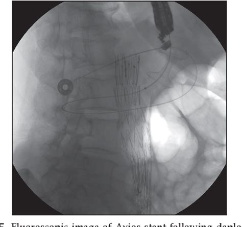 Figure From Endoscopic Ultrasound Guided Transmural Drainage Of