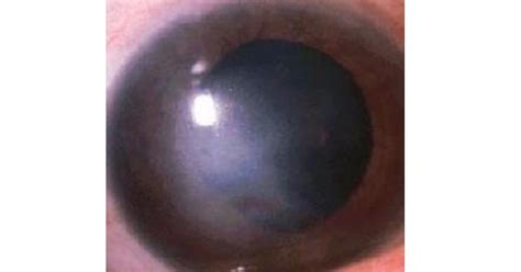 Interstitial keratitis - www.medicoapps.org