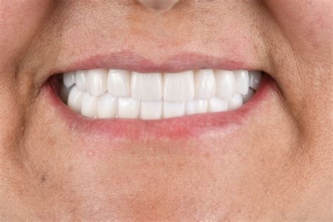 Veneers To Fix Tooth Imperfections Plainview Dental Plainview New York