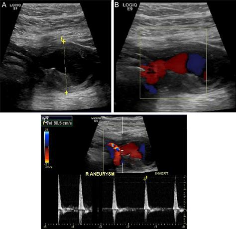 Peroneal Artery Ultrasound