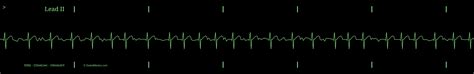 The Atrial Fibrillation Afib Ekg Ecg