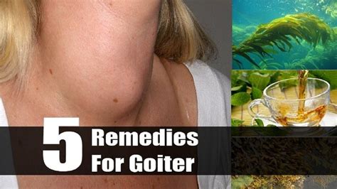 Goiter Treatment Home