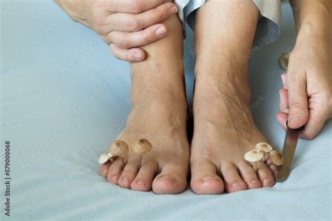 Fungi Grow Between The Toes On The Feet Concept Of Nail Fungus Skin