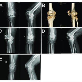 A 66-year-old male with a patellar fracture. (A) X-ray before surgery ...