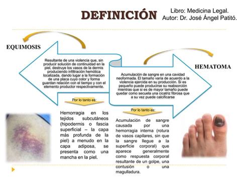 Diferencias Entre Equimosis Y Hematoma Su Valoración Médico Legal