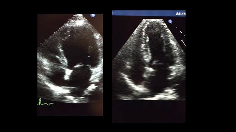 2d Echocardiogram Takotsubo Cardiomyopathy YouTube