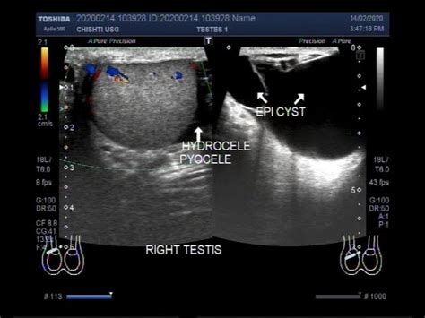 Testicular Cyst Ultrasound