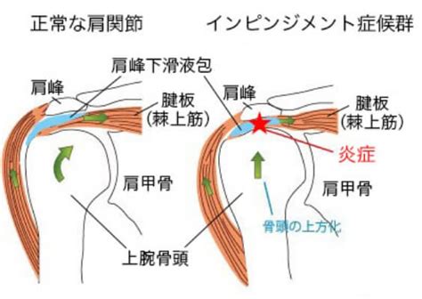 野球肩投球障害肩｜首・肩｜整形外科治療｜東京都渋谷区代官山｜drkakukoスポーツクリニック