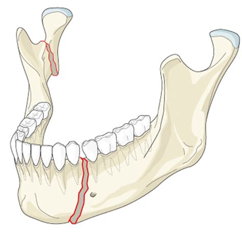 A Simultaneous Fracture Of The Mandibular Body And Ramus B The