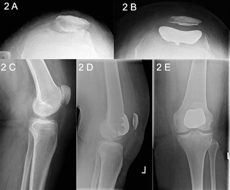 Patellofemoral joint (PFJ) arthritis. A. Skyline X-Ray showing PFJ ...