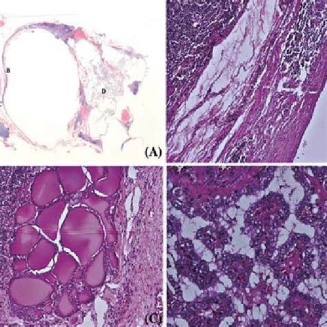 Degenerated Hassalls Corpuscles And Various Sized Cystic Spaces C Download Scientific