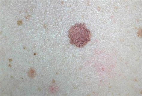 Mole Or Melanoma Test Yourself With These Suspicious Lesions