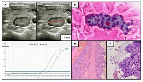 Example Of Us Cytological And Molecular Assessment Of A Thyroid Nodule