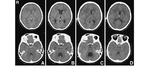 Computed Tomography Scans Showing Slit Like Ventricles And No