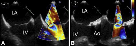 Transseptal Anchored Vascular Plug Closure Of Mitral Valve Perforation