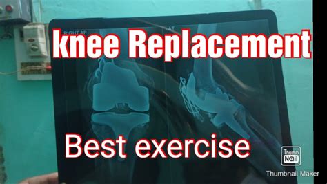 Knee Replacement Best Exercise Knee Mobilization Best Exercise Knee Strengthening Exercises