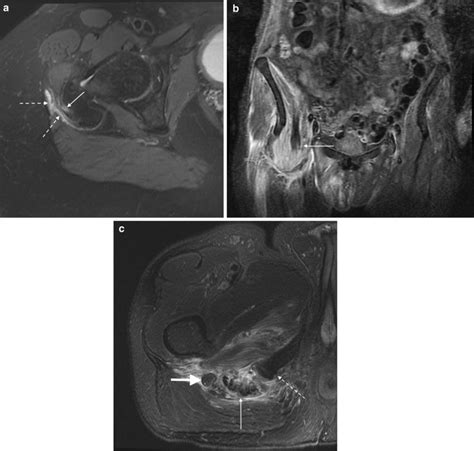 A Axial Fat Saturated T2 Weighted Mri Of The Right Hip In A 73 Year Old Download Scientific