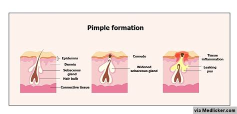 How To Get Rid Of Pimples Inside The Nose How To Get Rid Of Pimples