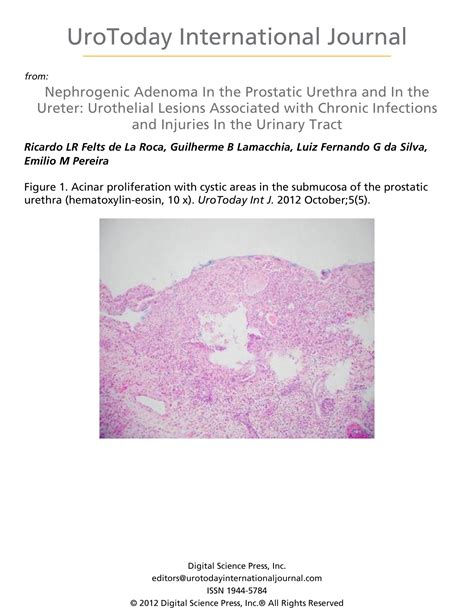 Nephrogenic Adenoma In The Prostatic Urethra And In The Ureter