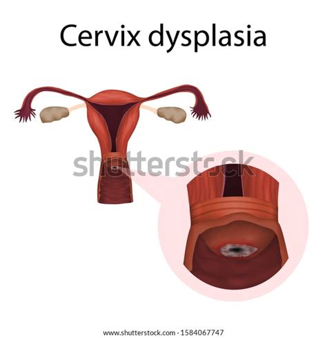 Cervix Dysplasia Cervical Disease Medical Anatomy Stock Illustration