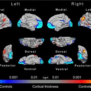 Statistical P Maps Showing Cortical Regions With Significant