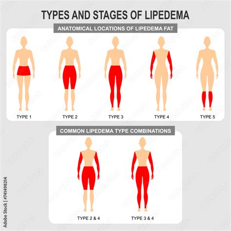 Lipedema Types and Stages condition Stock Vector | Adobe Stock