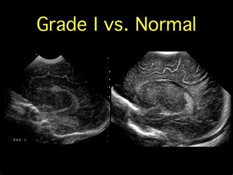 Normal Neonatal Brain Ultrasound Anatomy