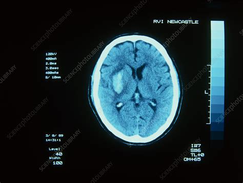 Ct Scan Of Cerebral Intracranial Haemorrhage Stock Image M136