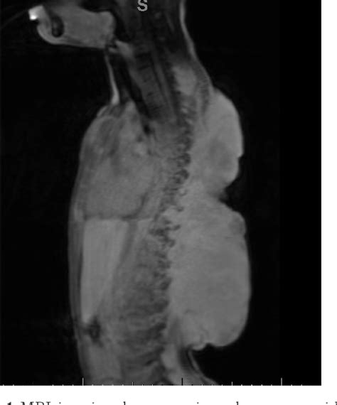 Figure From Management Of Rapidly Growing Recurrent Extra Abdominal