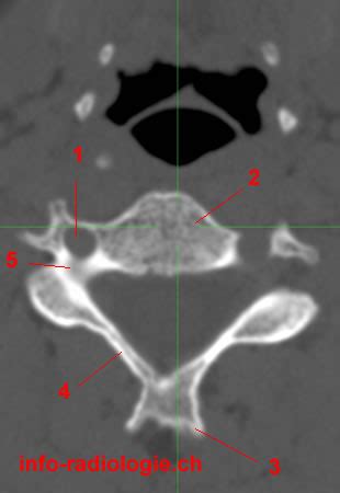 Scanner Du Rachis Cervical Anatomie