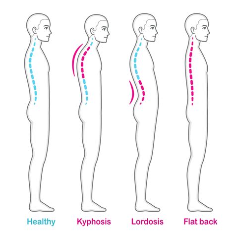 What is Flatback Syndrome? - Atlanta Brain and Spine Care