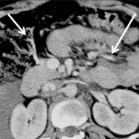 CT Abdomen Shows Abrupt Mesenteric Vessel Termination Long Arrow