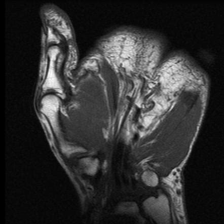 Fpl Tendon / Flexor Tendon Injuries Following Plate Fixation Of Distal ...