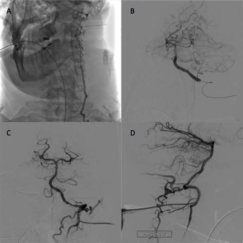 Direct Puncture Of The V Segment Of The Vertebral Artery In Acute