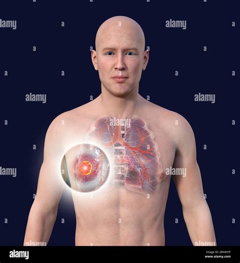 Lung cancer, illustration Stock Photo - Alamy