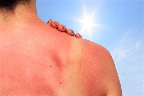 4 Steps To Treat Sunburn Abc Training