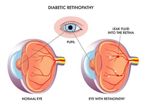 Diabetic Retinopathy - Pepose Vision