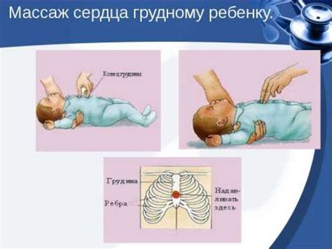 Сердечно-легочная реанимация у детей. Лекция 13 - online presentation