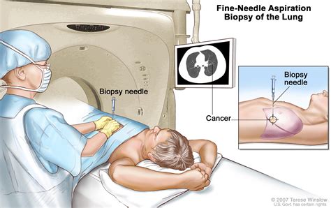 Small Cell Lung Cancer Treatment (PDQ®)—Patient Version - National ...