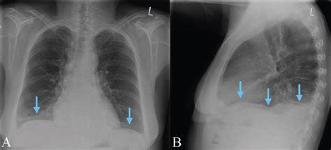 Pleural Effusion X Ray Lateral