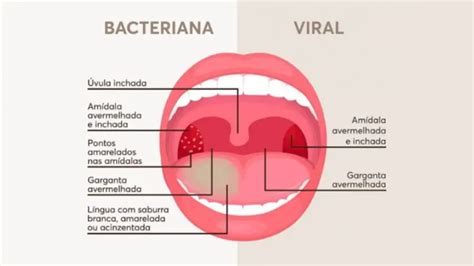 Amigdalite Sintomas Tratamentos E Causas