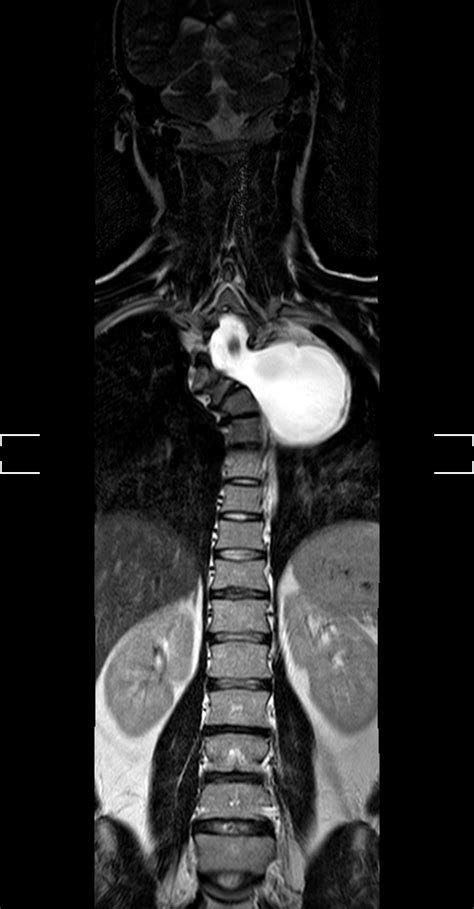 Lateral Thoracic Meningocele Image Radiopaedia Org