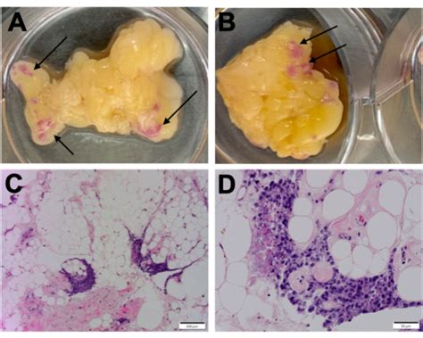 An Ex Vivo Model Of Ovarian Cancer Peritoneal Metastasis Using Human