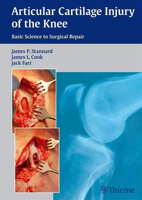 Articular Cartilage Injury Of The Knee Basic Science To Surgical