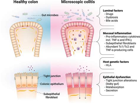 Microscopic Colitis Causes, Symptoms, Diagnosis & Treatment