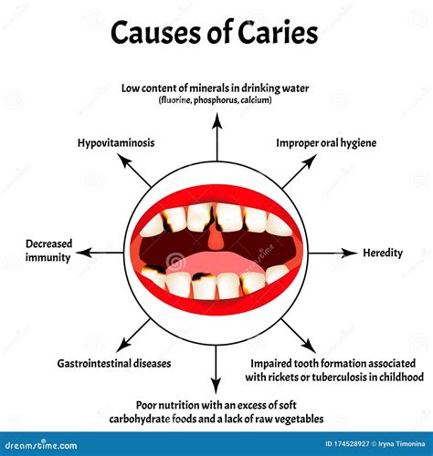 Causes Of Caries Poster Cartoon Vector | CartoonDealer.com #114024435