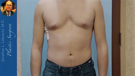 Gynecomastia Gland Removal Surgery On Patient With Pectus Excavatum By